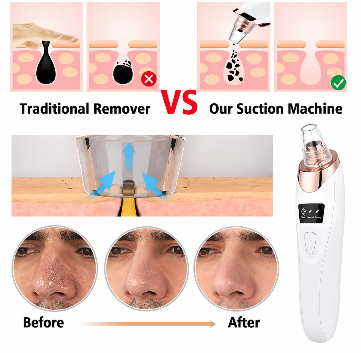 5 in 1 Blackhead Remover Machine Rechargeable | Face Vacuum Derma Suction With 5 Heads | Blackhead Removing Machine